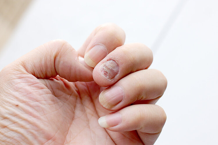 得了灰指甲，一个传染俩？小心灰指甲传染导致妇科病 - 3
