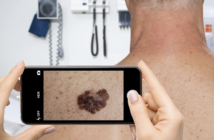 新App使用人工智能对皮肤状况进行分类并且进行准确诊断 - 2