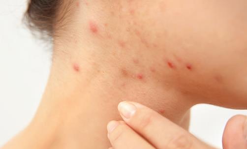 敏感性皮肤问答篇 皮肤过敏的十种防治措施 - 1