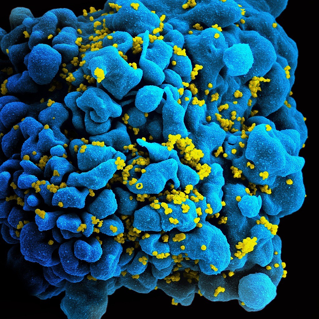 “埃斯佩兰萨患者”感染艾滋病8年后自愈 - 1