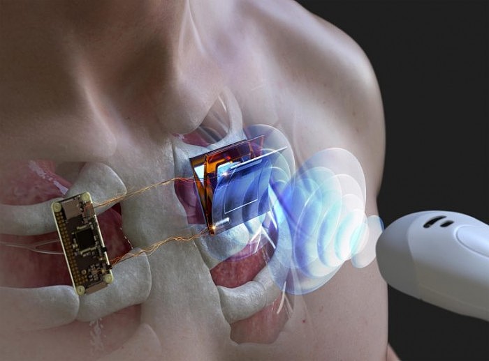 Wirelessly-Charging-Body-Implanted-Electronic-Device-768x568.jpg