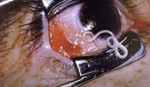 患者眼睛内的盘尾丝虫