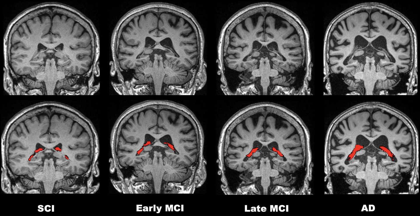 研究发现大脑中的脉络丛体积跟阿尔茨海默症有关 - 1