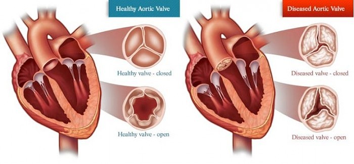 Heart-Aortic-Valve-Disease-777x360.jpg