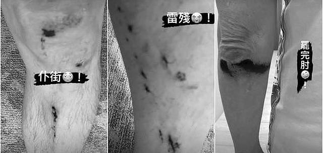 60岁庾澄庆突发意外！从车上摔下，膝盖手肘血流不止，被紧急送医 - 1