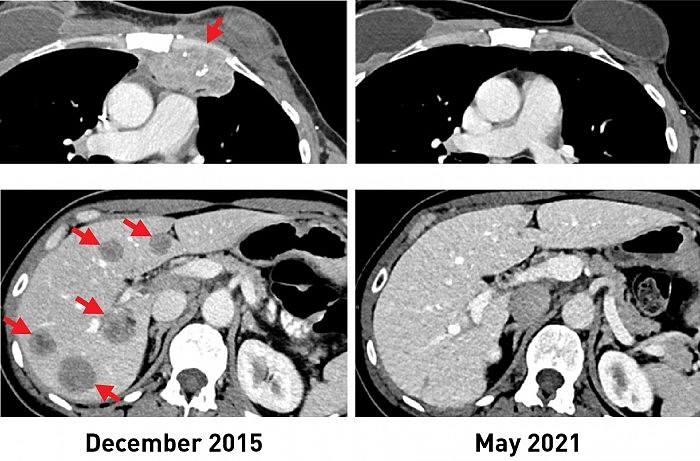 Breast-Cancer-Before-and-After-Immunotherapy.jpg