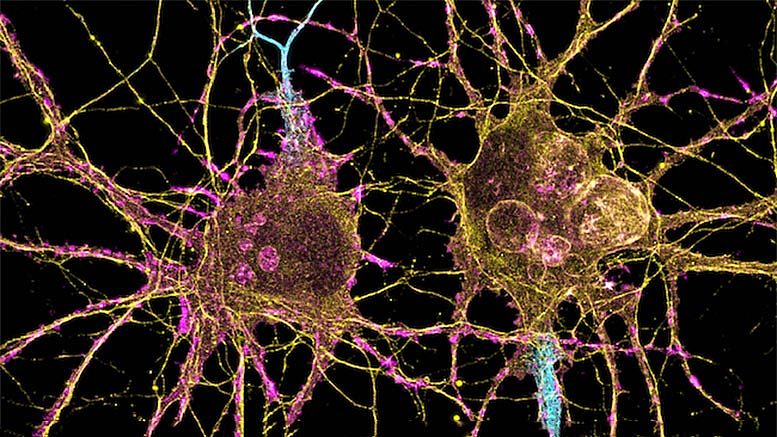新疗法或将可以阻止T细胞攻击帕金森患者的脑细胞 - 1