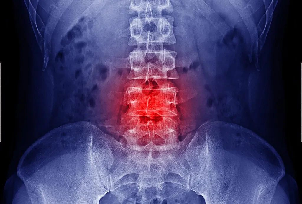 Intervertebral-Lumbar-Spine.webp