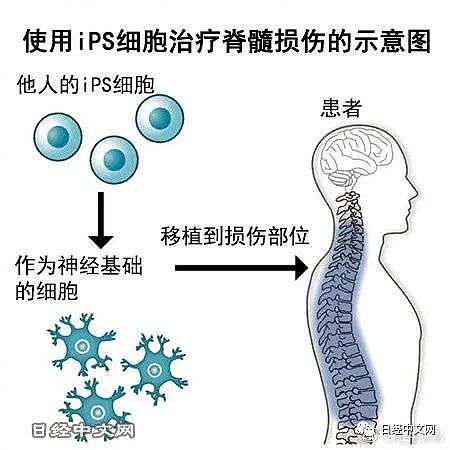 日本首次用iPS细胞治疗人类脊髓损伤 - 1