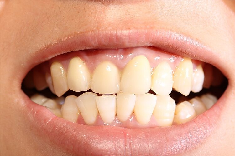 藏在牙缝中的“黄泥”到底是什么？为什么那么臭？告诉你答案 - 1