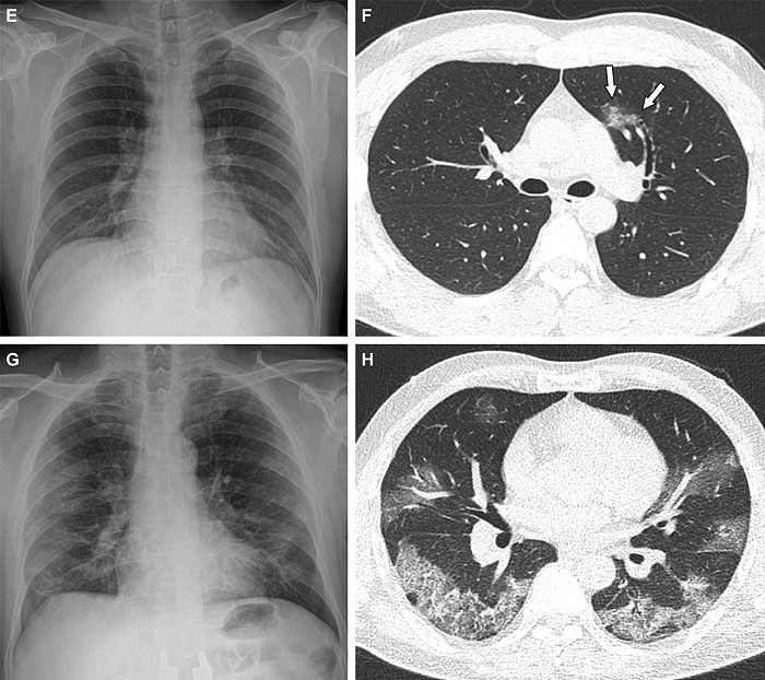 COVID-Pneumonia-No-Vaccination.jpg