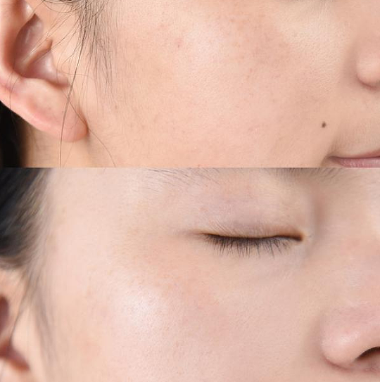 修正祛斑霜真的能去掉脸上的斑吗 修正祛斑霜使用方法 - 4