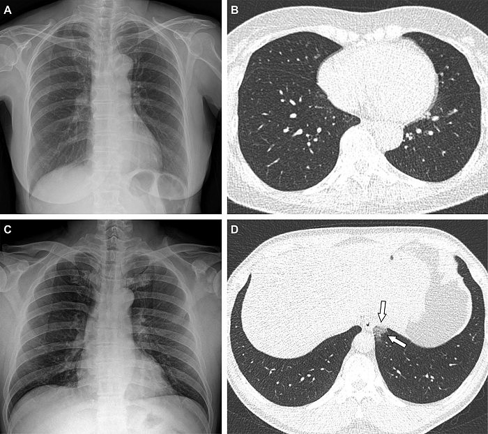 COVID-Pneumonia-Fully-Vaccinated.jpg