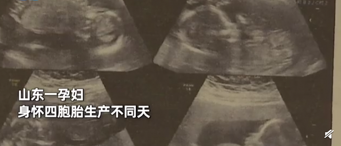 罕见：山东一孕妇身怀四胞胎生产不同天 医生释疑国内首例 - 1