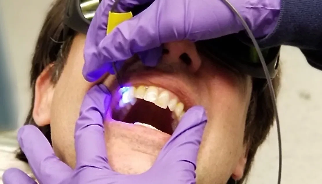 科学家研发新光学设备 可检测蛀牙高危区域 - 1