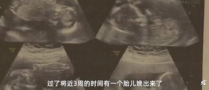 罕见：山东一孕妇身怀四胞胎生产不同天 医生释疑国内首例 - 2