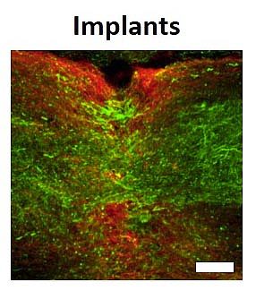 Visualization-of-a-Spinal-Cord-With-Treatment.jpg