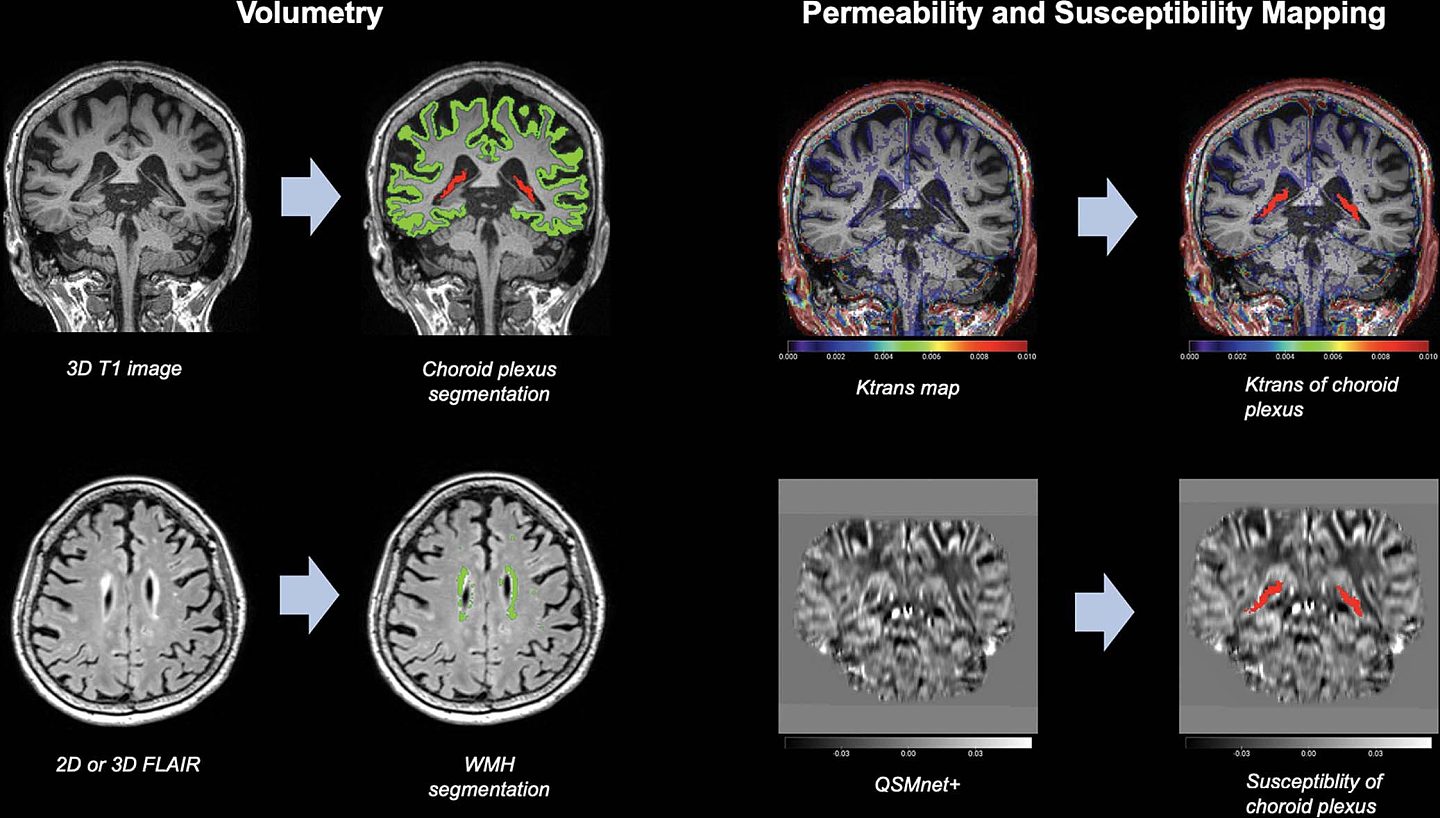 研究发现大脑中的脉络丛体积跟阿尔茨海默症有关 - 2