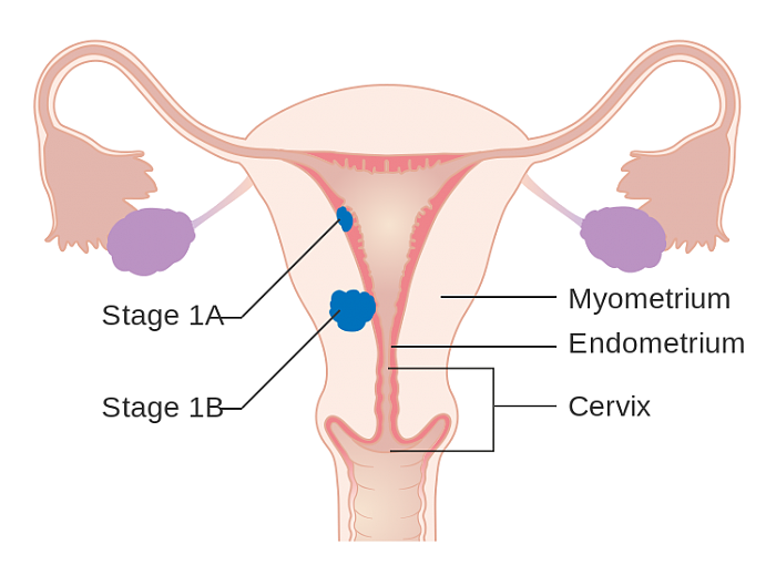 750px-Diagram_showing_stage_1A_and_1B_cancer_of_the_womb_CRUK_196.svg.png
