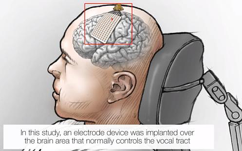 从脑瘫患者重获交流到免开颅微创，脑机接口更安全了吗？ - 1