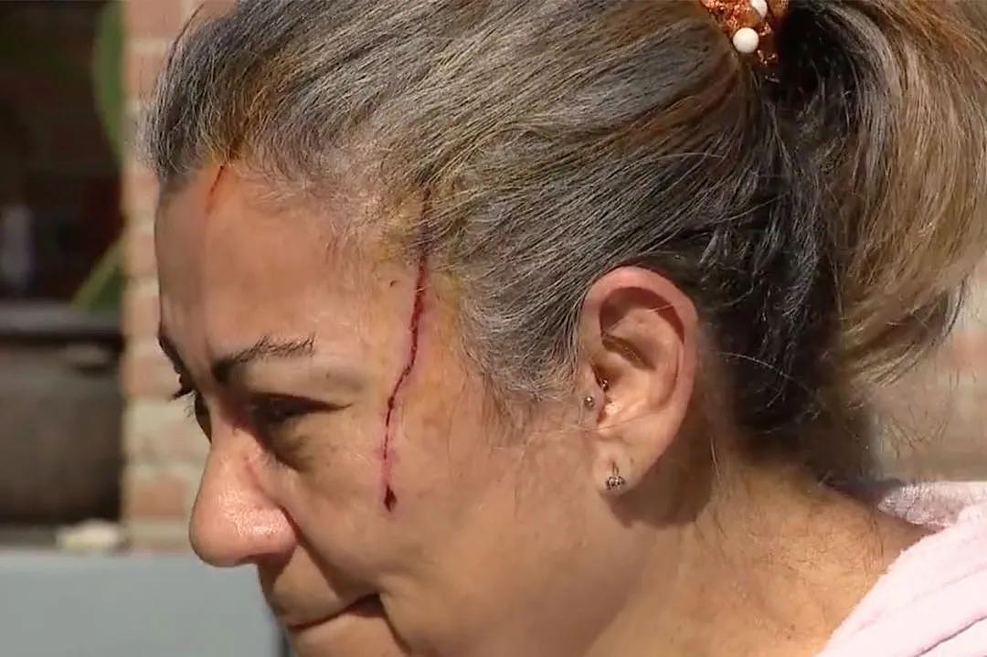 熊出没，注意！美国佛州一女子在自家门口遛狗时被黑熊袭击，导致面部撕裂！ - 1