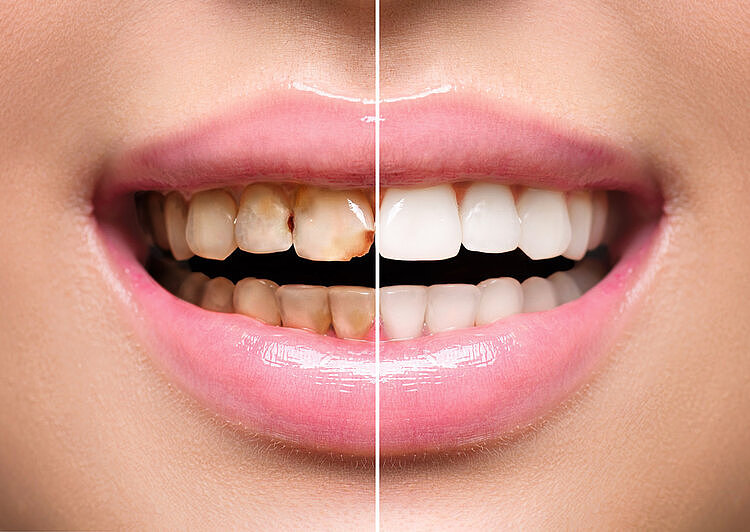 牙缝里的牙结石，如何清除干净？直言：这3个办法是不少人的选择 - 3