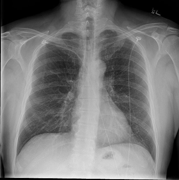 595px-Chest_x-ray_-_posteroanterior_view.jpg