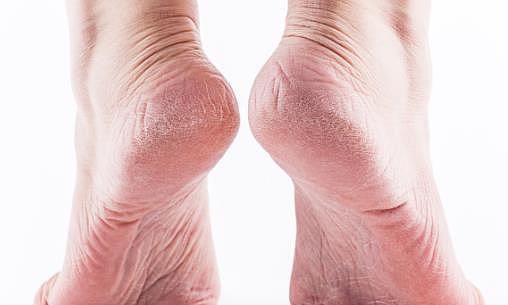 脚部干燥易脱皮教你护脚 脚脱皮的治疗方法有哪些 - 3