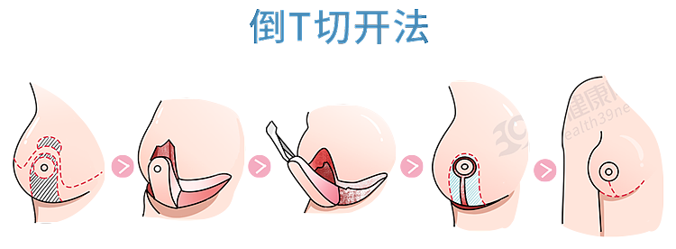 被“巨乳症”折磨的女生，有苦说不出！就像胸前挂着11瓶矿泉水 - 23