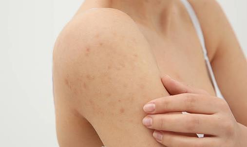 敏感性皮肤问答篇 皮肤过敏的十种防治措施 - 3