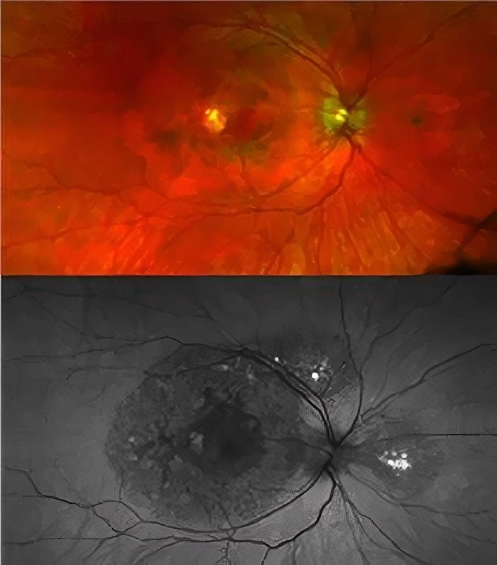 TIMP3-Retinopathy.jpg