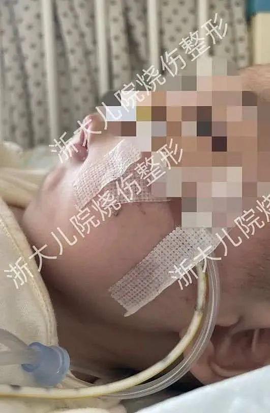 4 个月大的二胎宝宝竟然整了下巴？杭城医生提醒：这种面容可能有生命危险 - 2