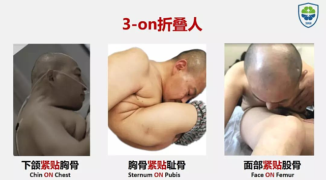 湖南折叠人：45岁男子脸贴大腿、身体折叠180度，16年后迎来新生 - 9