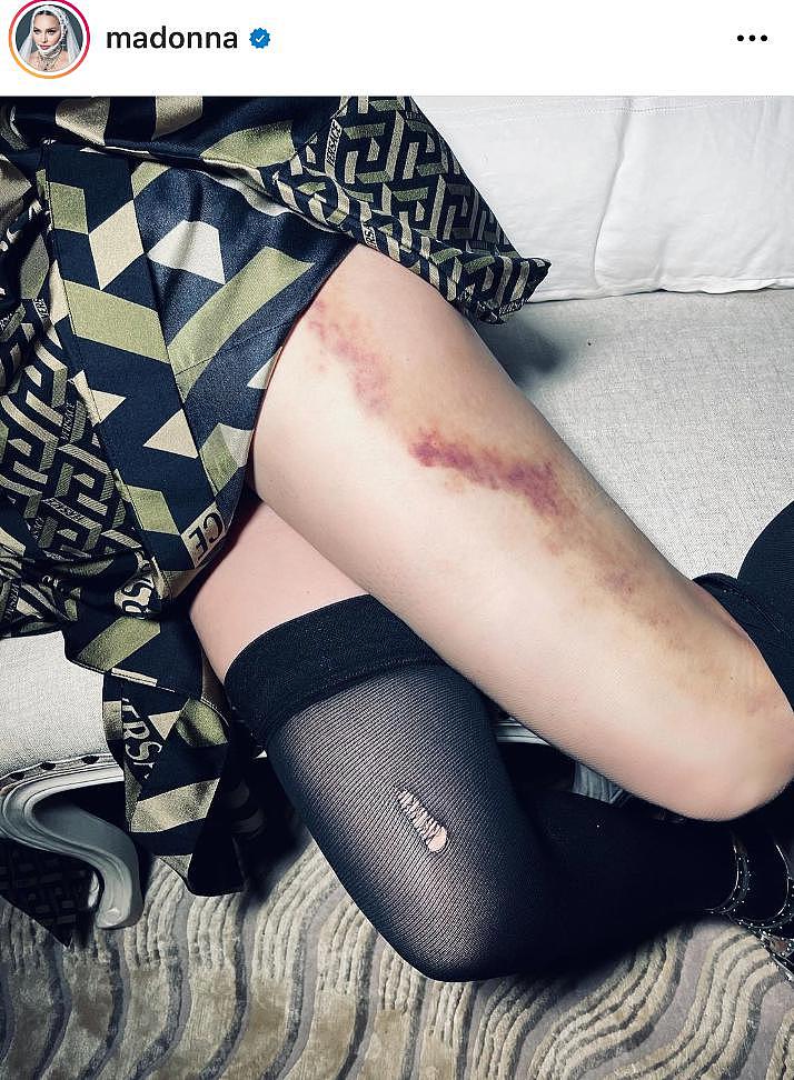63 岁麦当娜大腿受伤 穿黑丝腿部淤青红中泛紫太显眼 - 2