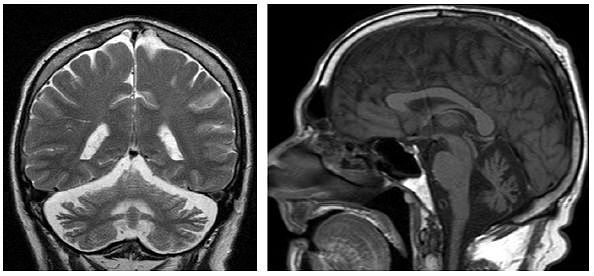 多图多表丨一文总结：小脑疾病的临床和影像学表现 - 7