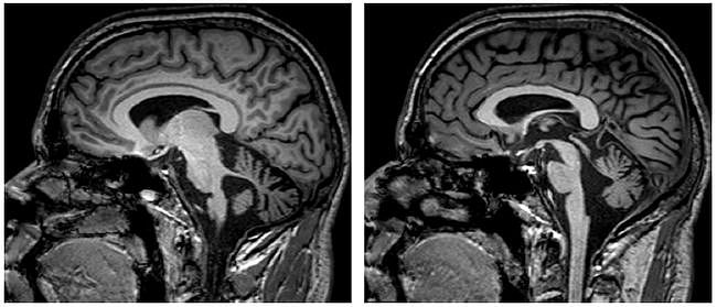 多图多表丨一文总结：小脑疾病的临床和影像学表现 - 11