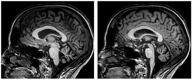 多图多表丨一文总结：小脑疾病的临床和影像学表现 - 15
