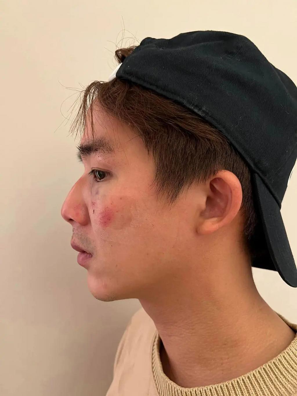 男星李博翔在街头被毒打伤势严重，女友上前劝架也遭殃 - 5