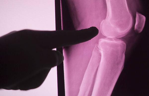 运动过后，膝盖隐隐作痛？或与这些因素有关，要及时检查 - 5
