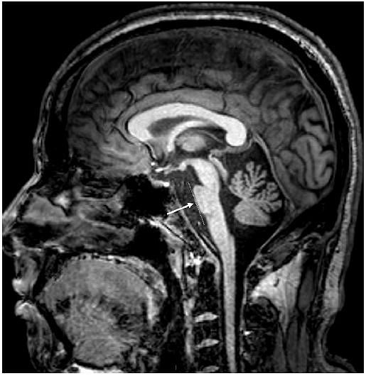 多图多表丨一文总结：小脑疾病的临床和影像学表现 - 18