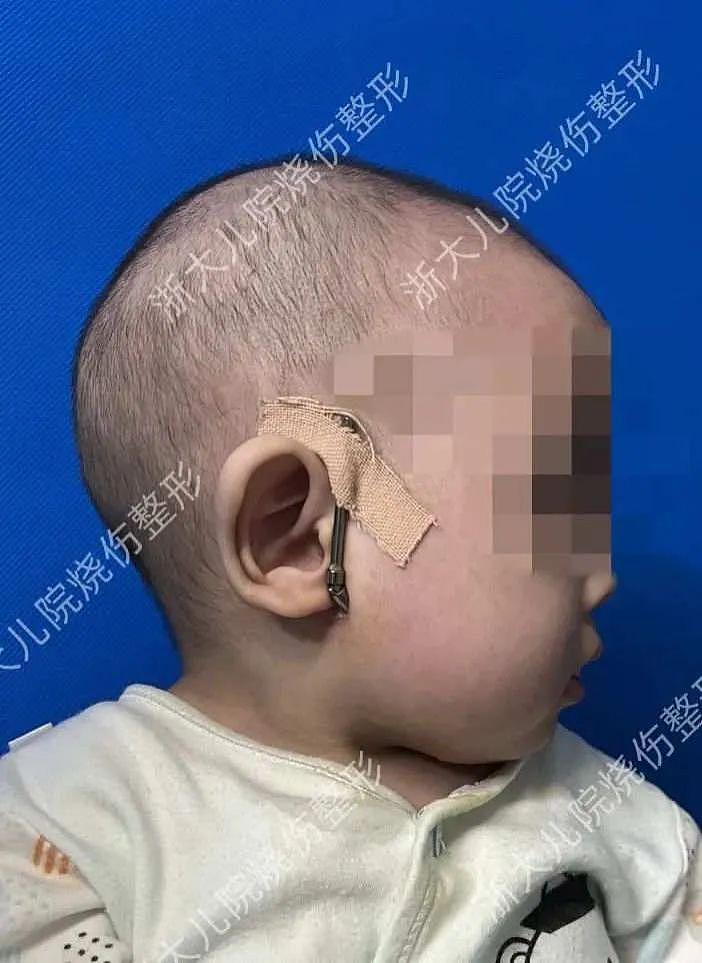 4 个月大的二胎宝宝竟然整了下巴？杭城医生提醒：这种面容可能有生命危险 - 3