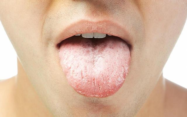 这样的齿痕舌：不仅仅提示气虚、湿气重，也提示脾胃虚弱！要注意 - 3
