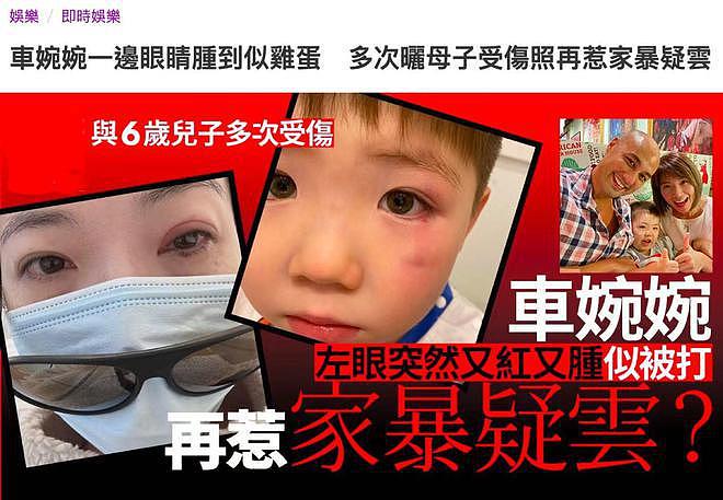 TVB 艺人车婉婉疑被家暴，曾多次晒母子受伤照 - 1