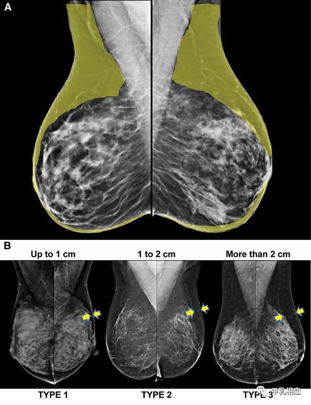 乳头保留乳房切除术中种植体重建的患者选择依据:术前乳腺x线照片 - 1