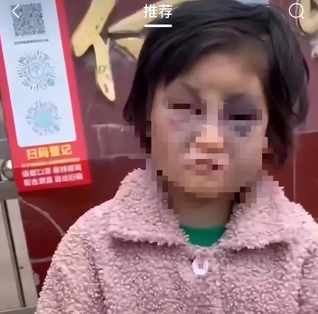 被打成“熊猫眼”女孩和弟弟被送至福利院，其母亲送至养老中心供养 - 1