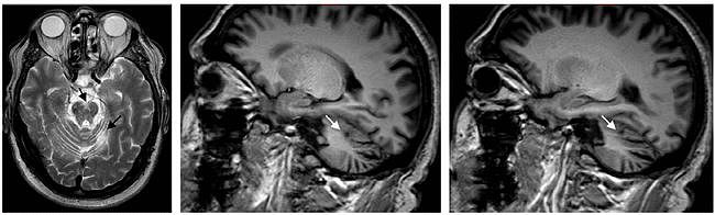 多图多表丨一文总结：小脑疾病的临床和影像学表现 - 5