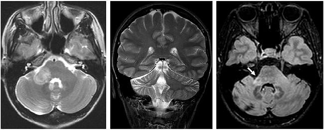 多图多表丨一文总结：小脑疾病的临床和影像学表现 - 6