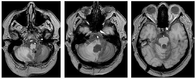 多图多表丨一文总结：小脑疾病的临床和影像学表现 - 10