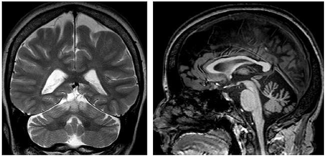 多图多表丨一文总结：小脑疾病的临床和影像学表现 - 14