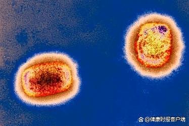 猴痘病毒疫情已出现人际传播，八问猴痘病毒疫情 - 1